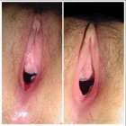 รอยแผลเป็น