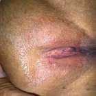 ก่อนกับหลังโกน